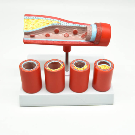 Модель «Здоровые и поврежденные сосуды» Модель «Здоровые и поврежденные сосуды»